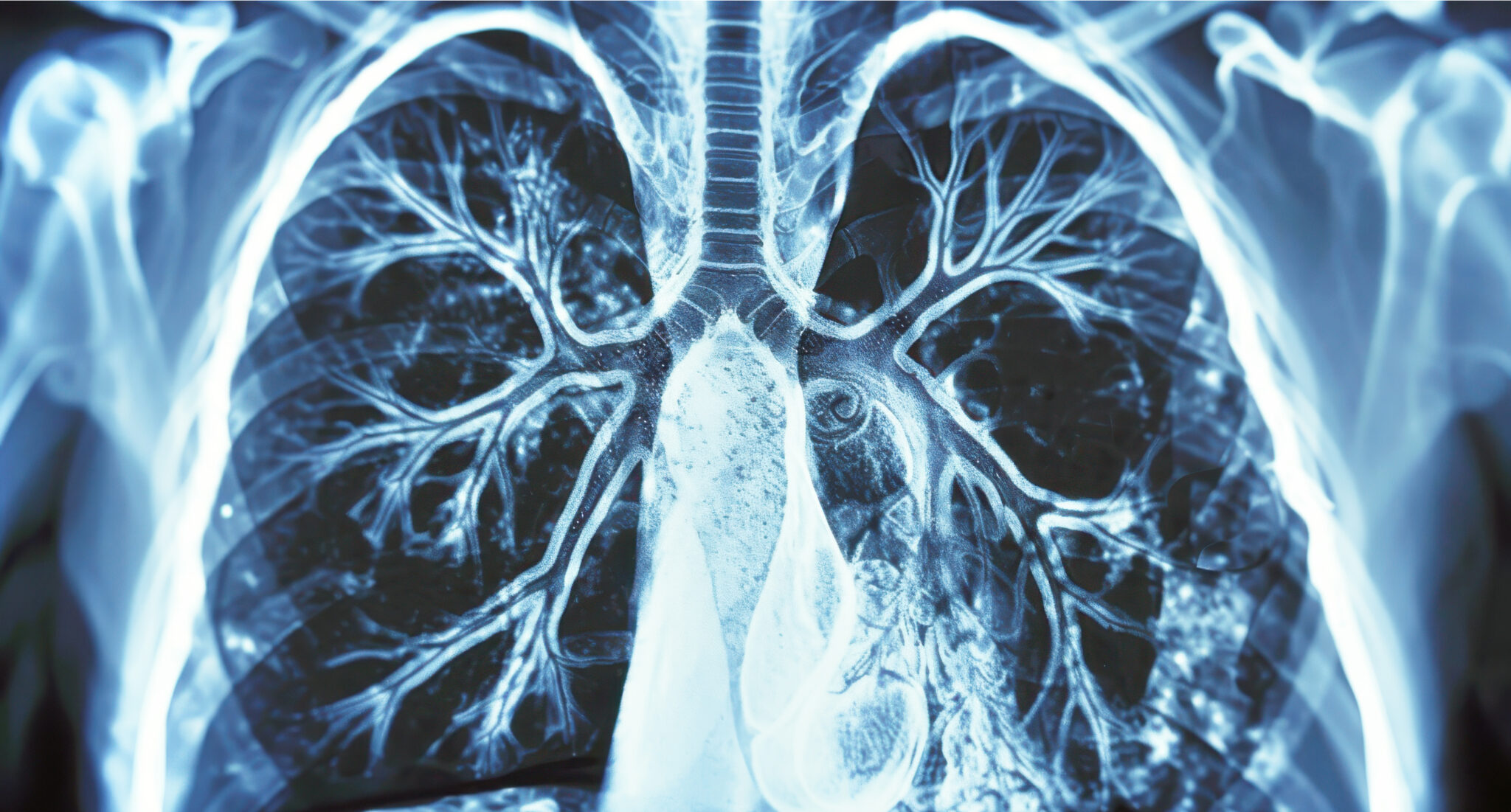 Color and ACS's Lung Cancer Screening Access Program Insights